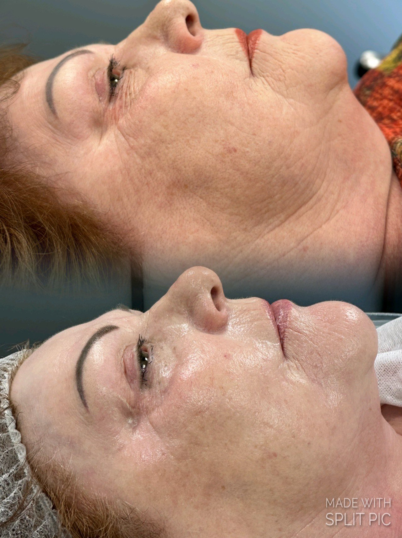 Profesionalus radijo dažnio aparatas veidui ir kūnui RFX3-3D PLUS - Image 4