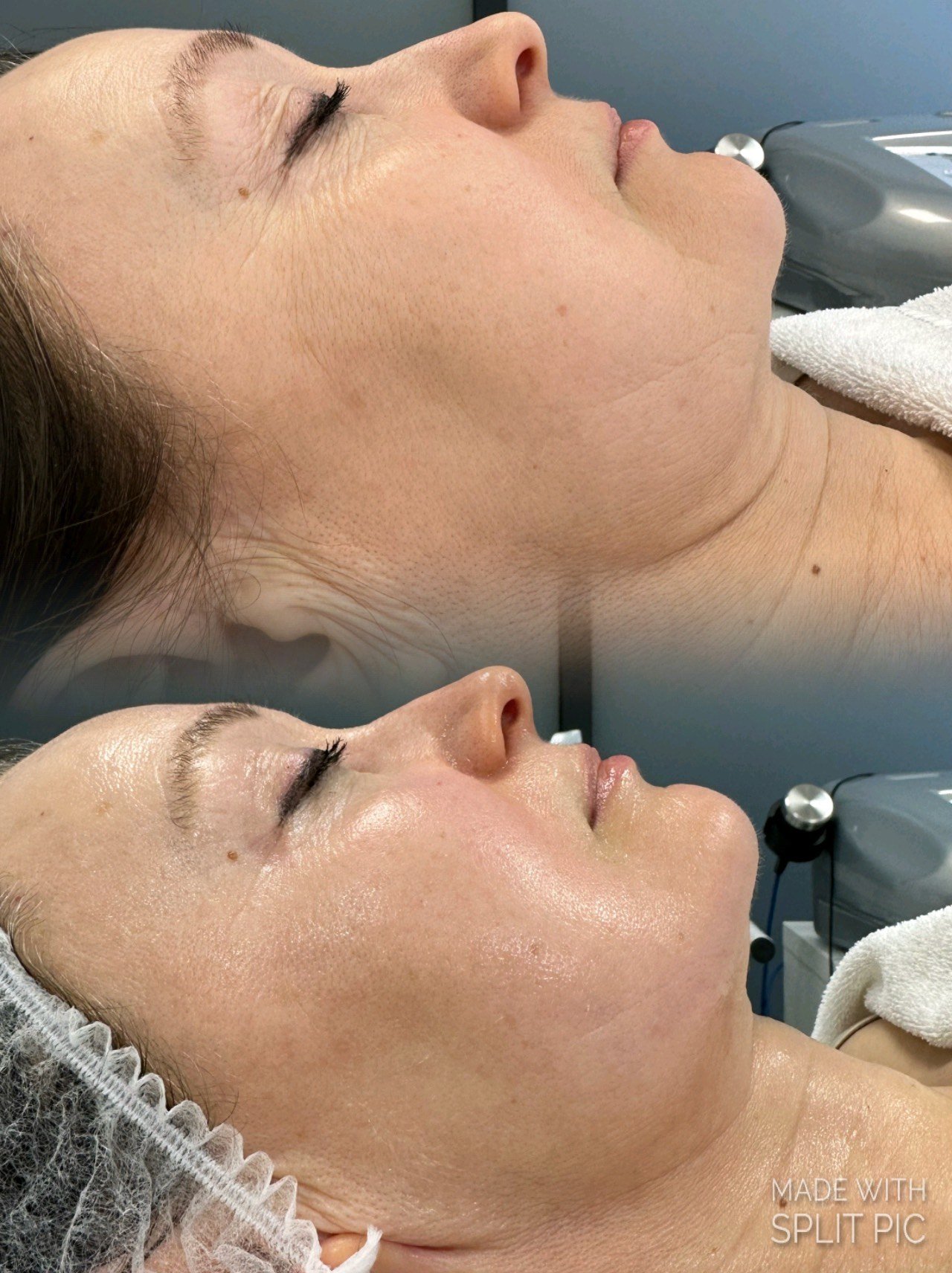 Profesionalus radijo dažnio aparatas veidui ir kūnui RFX3-3D PLUS - Image 6